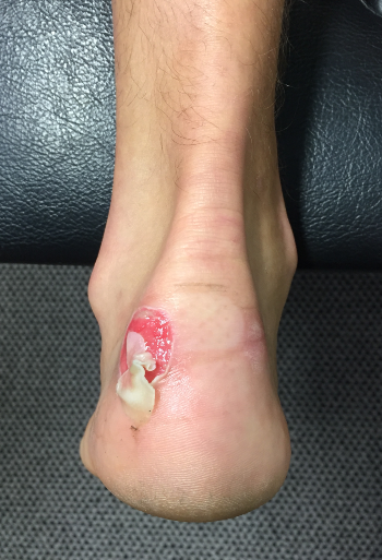 The truth about blisters